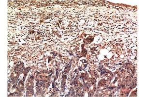 Immunohistochemical analysis of paraffin-embedded Human Stomach Carcinoma Tissue using Ubiquitin Mouse mAb diluted at 1:200. (Ubiquitin 抗体)
