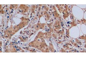 Detection of CDKN1B in Human Breast cancer Tissue using Polyclonal Antibody to Cyclin Dependent Kinase Inhibitor 1B (CDKN1B) (CDKN1B 抗体  (AA 1-198))