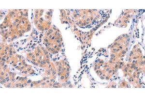 Immunohistochemistry of paraffin-embedded Human lung cancer tissue using VWF Polyclonal Antibody at dilution 1:50 (VWF 抗体)