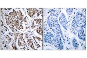 Immunohistochemical analysis of paraffin-embedded human breast carcinoma tissue using BAD (phospho- Ser155) antibody. (BAD 抗体  (pSer155))