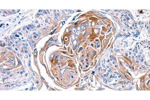 Immunohistochemistry of paraffin-embedded Human esophagus cancer tissue using CX3CL1 Polyclonal Antibody at dilution 1:30 (CX3CL1 抗体)