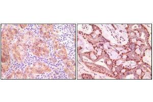 Immunohistochemical analysis of paraffin-embedded human ovary carcinoma (left) and breast carcinoma (right), showing cytoplasmic(ovary carcinoma) localization, cytoplasmic and nuclear (breast carcinoma) localization using SNCG mouse mAb with DAB staining. (SNCG (Breast Cancer-Specific Protein 1) 抗体)