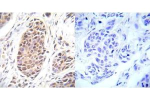 Immunohistochemical analysis of paraffin- embedded human breast carcinoma tissue using FOXO3A (Ab-253) antibody (E022020). (FOXO3 抗体)