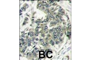 Formalin-fixed and paraffin-embedded human breast carcinoma reacted with EIF4E antibody (N-term) (ABIN388675 and ABIN2838633) , which was peroxidase-conjugated to the secondary antibody, followed by DAB staining. (EIF4E 抗体  (N-Term))