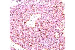 IHC testing of human small cell lung carcinoma stained with chromogranin A antibody cocktail (clones LK2H10 + PHE5 + CGA414). (Chromogranin A 抗体)