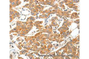 Immunohistochemistry of Human cervical cancer using ADAMTS18 Polyclonal Antibody at dilution of 1:30 (ADAMTS18 抗体)