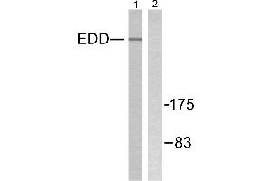 Immunohistochemistry analysis of paraffin-embedded human breast carcinoma tissue using EDD antibody. (UBR5 抗体)