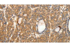 Immunohistochemistry of paraffin-embedded Human thyroid cancer tissue using SYT11 Polyclonal Antibody at dilution 1:30 (SYT11 抗体)