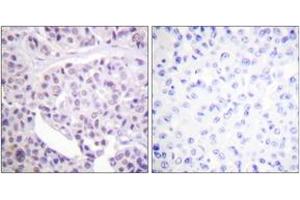 Immunohistochemistry analysis of paraffin-embedded human breast carcinoma tissue, using p53 (Ab-392) Antibody. (p53 抗体  (AA 344-393))