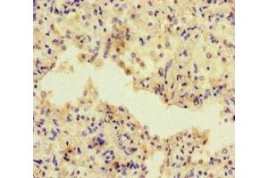 Immunohistochemistry of paraffin-embedded human lung cancer using ABIN7143320 at dilution of 1:100 (ADCY1 抗体  (AA 416-610))