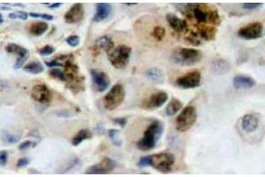 Immunohistochemistry (IHC) analyzes of FoxO4 antibody in paraffin-embedded human breast carcinoma tissue. (FOXO4 抗体)