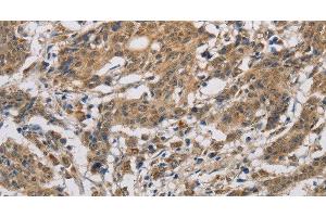 Immunohistochemistry of paraffin-embedded Human gastric cancer using CYCS Polyclonal Antibody at dilution of 1:50 (Cytochrome C 抗体)