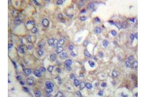 Immunohistochemistry analyzes of Flg antibody in paraffin-embedded human breast carcinoma tissue. (FGFR1 抗体)