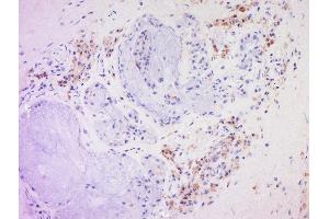 Formalin-fixed and paraffin embedded human larynocarcinoma labeled with Anti-CD20 Polyclonal Antibody, Unconjugated  at 1:200 followed by conjugation to the secondary antibody and DAB staining. (CD20 抗体  (AA 133-182))