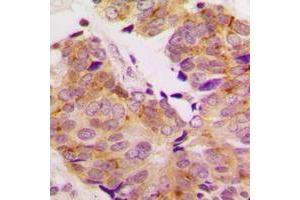 Immunohistochemical analysis of S6K1 staining in human breast cancer formalin fixed paraffin embedded tissue section. (RPS6KB1 抗体  (C-Term))