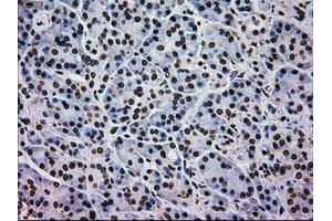 Immunohistochemical staining of paraffin-embedded Adenocarcinoma of colon tissue using anti-MAPK1mouse monoclonal antibody. (ERK2 抗体)