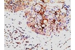 IHC testing of FFPE human breast carcinoma with EPS8 antibody at 5ug/ml. (EPS8 抗体)