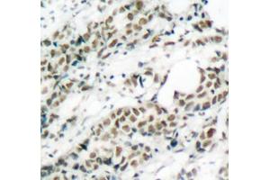 Immunohistochemistry of paraffin-embedded human breast carcinoma tissue, using Phospho-FOXO4-S197 antibody (ABIN3019724, ABIN3019725, ABIN3019726 and ABIN1681609). (FOXO4 抗体  (pSer197))