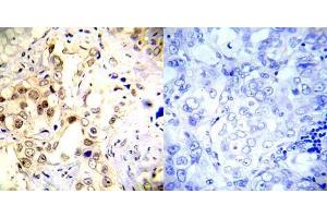 Immunohistochemical analysis of paraffin-embedded human breast carcinoma tissue using P53 (phospho- Ser20) antibody (E012030). (p53 抗体  (pSer20))