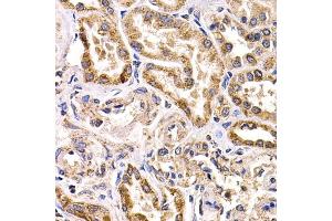 Immunohistochemistry of paraffin-embedded human kidney cancer using FZR1 antibody (ABIN5973232) at dilution of 1/200 (40x lens). (FZR1 抗体)