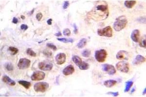 Immunohistochemistry (IHC) analyzes of p-ATM antibody in paraffin-embedded human breast carcinoma tissue. (ATM 抗体  (pSer1981))