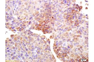 Formalin-fixed and paraffin embedded human bladder carcinoma labeled with Anti-Cancer/testis antigen 1B/1A Polyclonal Antibody, Unconjugated (ABIN1385260) at 1:200 followed by conjugation to the secondary antibody and DAB staining. (Testis Antigen 1 (AA 75-180) 抗体)