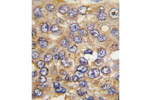 Immunohistochemistry (IHC) image for anti-6-phosphofructo-2-Kinase/fructose-2,6-Biphosphatase 4 (PFKFB4) antibody (ABIN3003725) (PFKFB4 抗体)