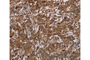 Immunohistochemistry of Human liver cancer using TBX5 Polyclonal Antibody at dilution of 1:35 (T-Box 5 抗体)
