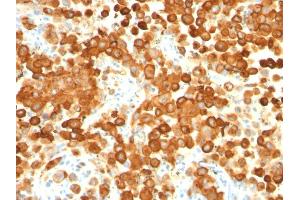 Formalin-fixed, paraffin-embedded human Melanoma stained with gp100 / Melanosome Monoclonal Antibody (HMB45 + PMEL/783). (Melanoma gp100 抗体)