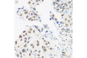 Immunohistochemistry of paraffin-embedded human prostate cancer using DDX39B antibody (ABIN5974669) at dilution of 1/100 (40x lens). (DDX39B 抗体)