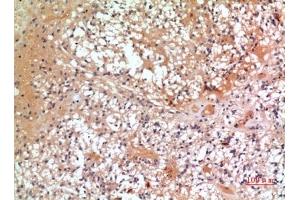 Immunohistochemical analysis of paraffin-embedded human-oophoroma, antibody was diluted at 1:100. (CMTM6 抗体  (C-Term))