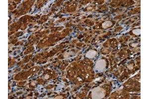 The image on the left is immunohistochemistry of paraffin-embedded Human thyroid cancer tissue using ABIN7191558(MYBBP1A Antibody) at dilution 1/40, on the right is treated with synthetic peptide. (MYBBP1A 抗体)