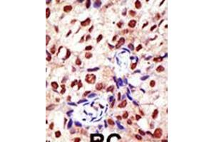 Formalin-fixed and paraffin-embedded human cancer tissue reacted with the primary antibody, which was peroxidase-conjugated to the secondary antibody, followed by DAB staining. (PRMT2 抗体  (N-Term))