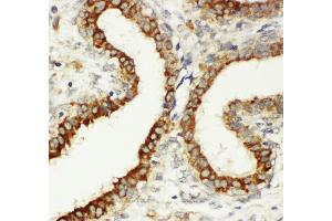 Anti-Integrin beta 3 antibody, IHC(P) IHC(P): Human Mammary Cancer Tissue (Integrin beta 3 抗体  (C-Term))