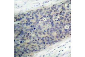Immunohistochemistry of paraffin-embedded human breast carcinoma using Phospho-LIMK2-T505 antibody (ABIN2988124). (LIMK2 抗体  (pThr505))