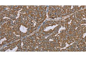 Immunohistochemistry of paraffin-embedded Human ovarian cancer using CERS4 Polyclonal Antibody at dilution of 1:35 (LASS4 抗体)