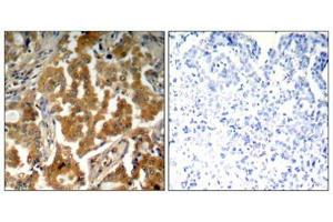 Immunohistochemical analysis of paraffin-embedded human lung carcinoma tissue using ADD1(Phospho-Ser726) Antibody(left) or the same antibody preincubated with blocking peptide(right). (alpha Adducin 抗体  (pSer726))