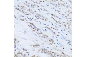 Immunohistochemistry of paraffin-embedded human colon carcinoma using CDKN1A antibody (ABIN5995726) at dilution of 1/100 (40x lens). (p21 抗体)