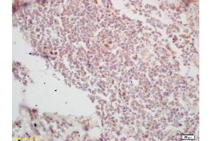 Formalin-fixed and paraffin embedded human lung carcinoma labeled with Rabbit Anti Histone H3-like protein Polyclonal Antibody, Unconjugated (ABIN670986) at 1:200 followed by conjugation to the secondary antibody and DAB staining (Centromeric Histone H3-Like Protein-2 (AA 51-145) 抗体)