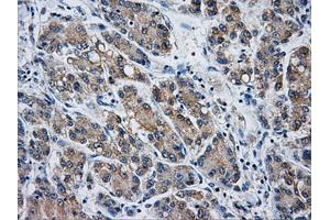 Immunohistochemical staining of paraffin-embedded Carcinoma of liver tissue using anti-AKR1A1mouse monoclonal antibody. (AKR1A1 抗体)