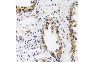 Immunohistochemistry of paraffin-embedded human prostate using SAFB2 antibody. (SAFB2 抗体)