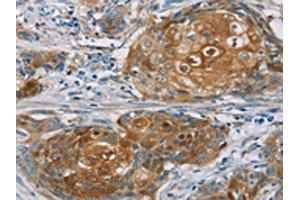 The image on the left is immunohistochemistry of paraffin-embedded Human cervical cancer tissue using ABIN7192209(RORB Antibody) at dilution 1/30, on the right is treated with synthetic peptide. (RORB 抗体)