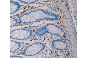 DAB staining on IHC-P; Samples: Human Rectum Cancer Tissue (TPSAB1 抗体  (AA 161-262))