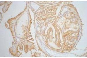 Immunohistochemistry of paraffin-embedded Human thyroid tissue using Galectin 3 Monoclonal Antibody at dilution of 1:200. (Galectin 3 抗体)