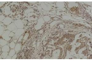 Immunohistochemistry of paraffin-embedded Human breast carcinoma tissue with Pan Methylated Lysine Monoclonal Antibody(Mix). (Methylated Lysine 抗体)