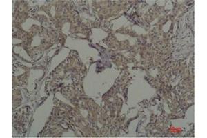 Immunohistochemical analysis of paraffin-embedded Human Breast Caricnoma using c-FosMouse mAb diluted at 1:200. (c-FOS 抗体)