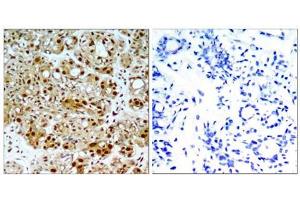 Immunohistochemical analysis of paraffin-embedded human breast carcinoma tissue, using HSP90B (Ab-254) antibody (E021290). (HSP90AB1 抗体)