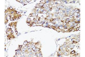 Immunohistochemistry of paraffin-embedded human liver cancer using MTOR antibody. (MTOR 抗体)