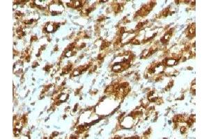 Formalin-fixed, paraffin-embedded human rhabdomyosarcoma stained with pan Muscle Actin antibody (MSA/953) (Pan Muscle Actin 抗体)