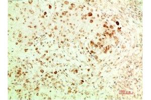 Immunohistochemical analysis of paraffin-embedded Human Ovarian Carcinoma Tissue using ATG5 Mouse mAb diluted at 1:200. (ATG5 抗体)